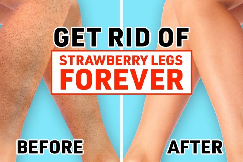 Strawberry Legs Treatment